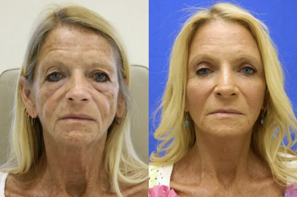Facelift Connecticut: Dr. Paul Stanislaw
