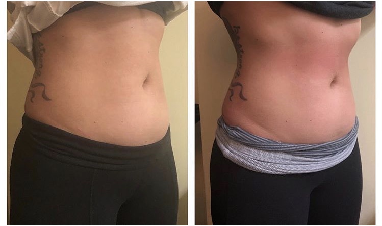 Long Island Body Sculpting