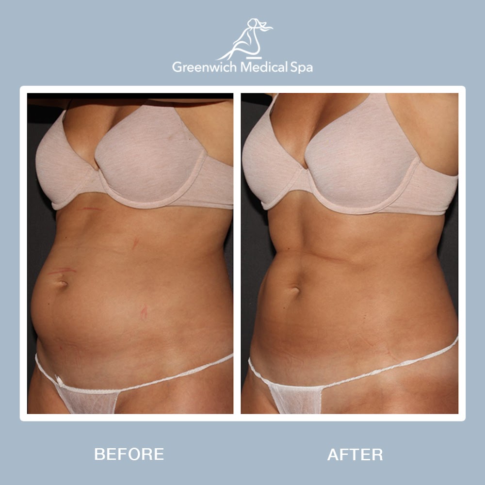 CoolSculpting & Emsculpt Center Westport